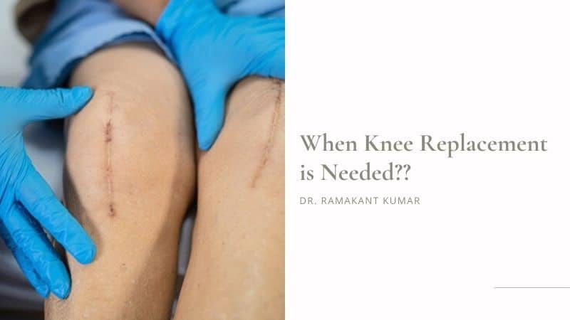 When Knee Replacement is Needed