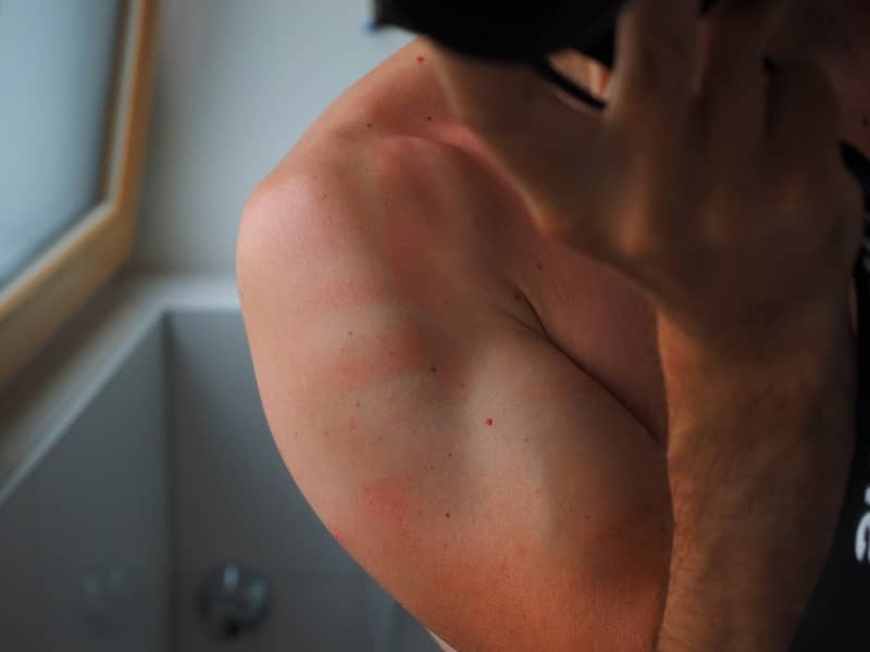 dangers of severe sunburn