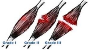 Muscle strain grades