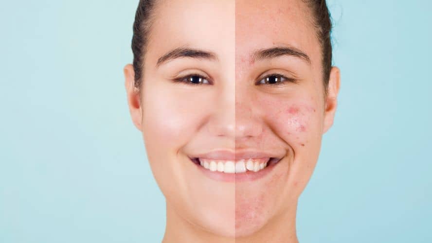 how to get rid of acne fastest way